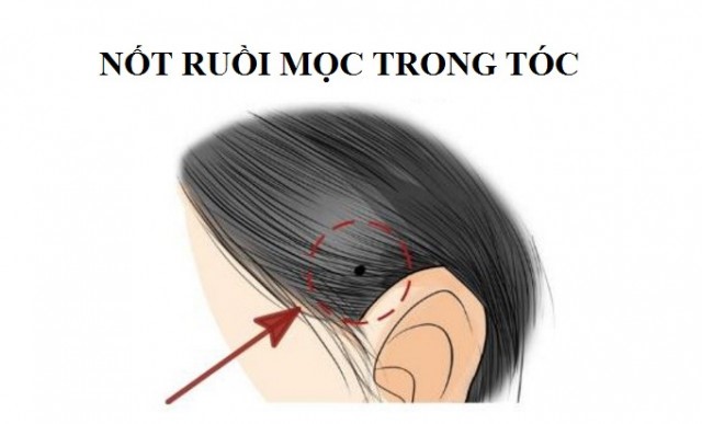 Nốt ruồi trong tóc định số mệnh giàu sang hay nghèo hèn