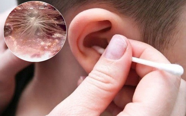 Ngứa tai phải có thể là một trong những biểu hiện của bệnh viêm ống tai ngoài.
