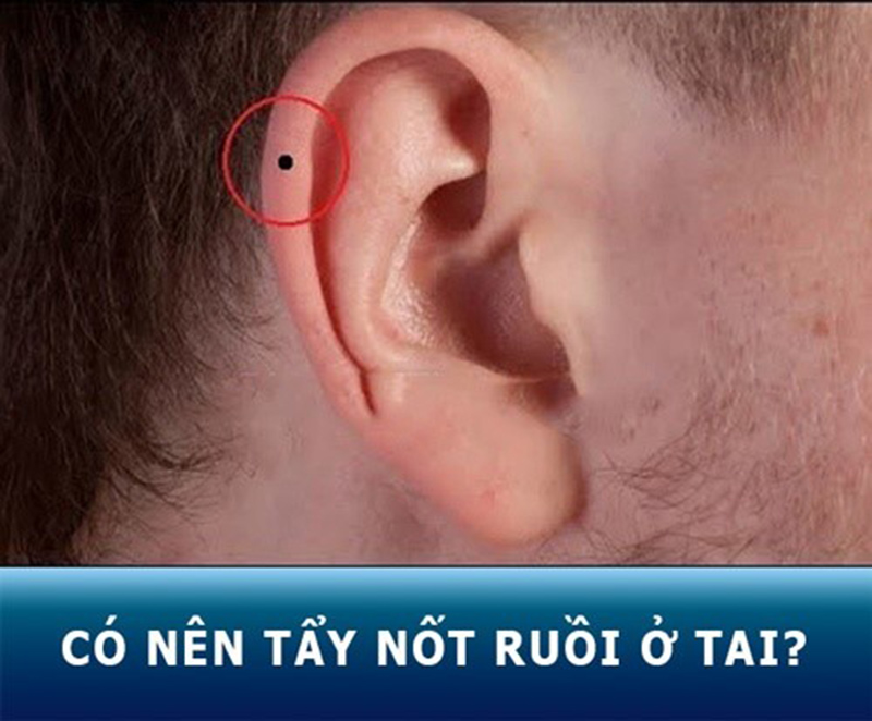 GameNhanh.Com - Xem tướng Nốt ruồi ở Tai ở bên Trái, Phải của Nam, Nữ chính xác 13