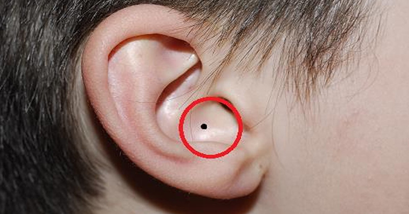 Vị trí Nốt ruồi nằm bên trong tai
