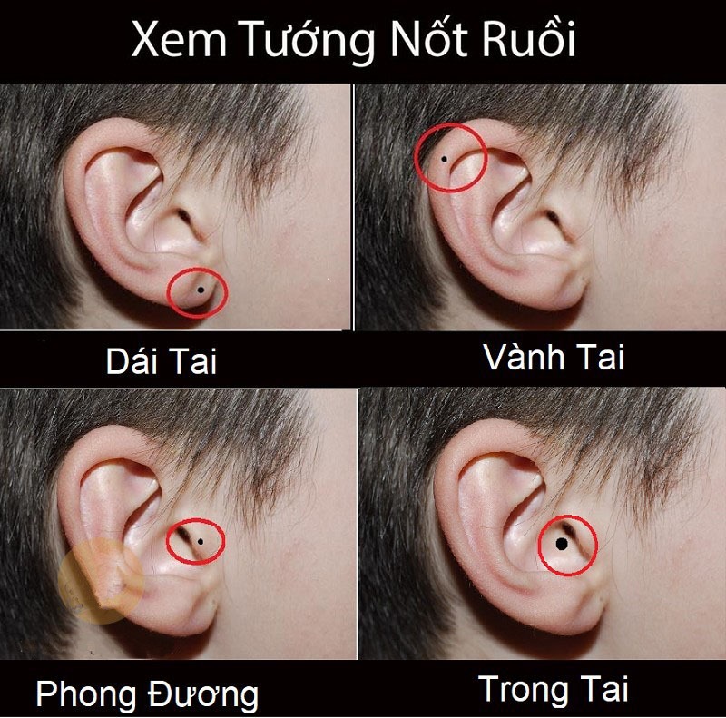 Ý nghĩa Nốt ruồi ở tai của nam & nữ là Điềm lành hay dữ?