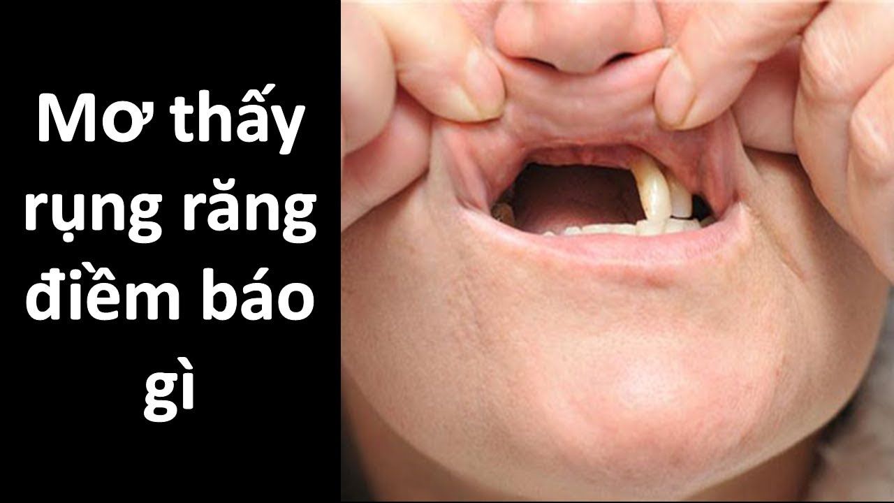 Nằm mơ thấy rụng răng là điềm gì, hên hay xui, đánh con gì? Nằm mơ thấy rụng răng là điềm gì, hên hay xui, đánh con gì?