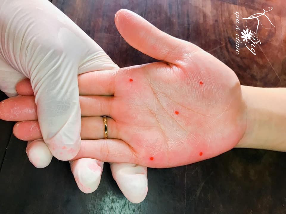 Xem Tướng Nốt Ruồi Son Trong Lòng Bàn Tay