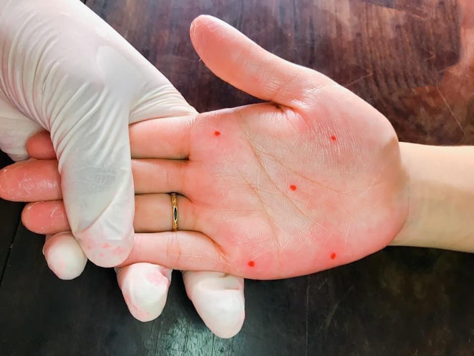 Xăm Nốt Ruồi Son Trên Tay