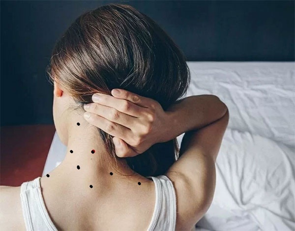 8 nốt ruồi sau gáy nữ là tín hiệu cho thấy bạn sẽ có một cuộc sống không dựa vào chồng hoặc có thể gặp khó khăn về đường con cái.